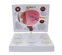 Pathological Eye Model - Human Eye with Cataracts and Cornea for Teaching - Anatomical Eyeball Demonstration Model for Educational Purposes