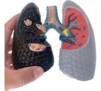 Pathological Lung Anatomy Model - Comparison of Healthy and Smoking Lungs with Tracheal Demonstration