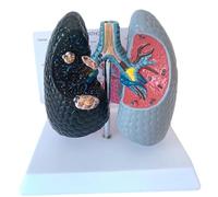 Pathological Lung Anatomy Model, Health vs Smoking Lung Comparison, Tracheal Demonstration for Medical Education