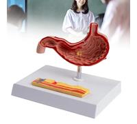 Pathological Stomach Model - Human Digestive System Anatomy Simulator Showing Gastritis, Ulcers & Gastric Cancer - Medical Teaching Aid for Gastroenterology, Patient Education & Lab Display