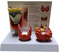Pathological Thyroid Model Teaching Model Thyroid Anatomy Model Thyroid Nodule Model Human Organ Anatomical Model Thyroid Disease Model