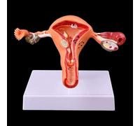 Pathological Uterus and Ovary Anatomical Model Pathological Model of The Uterus Human Female Anatomical Cross-sectional Study Model