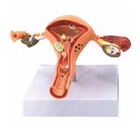 Pathological Uterus and Ovary Model, Female Reproductive Anatomy Model Teaching Aids for Demonstrations Doctor's Offices and Anatomy Study