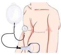 Pectus Excavatum Corrector - Non-Surgical Funnel Chest Brace for Deformity Correction in Adults and Teens, Effective Physical Therapy Device