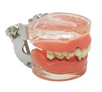 Periodontal disease model Teeth Cure Sarro Education Study study teaching model