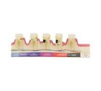 Periodontitis Typodont Model - Dental Training Aid For Demonstrating Periodontitis Stages And Treatment Techniques