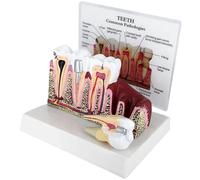 POCDOKYZ Standard Dental Oral Teeth, Anatomical Teaching Model,Human Tooth Disease Tooth Decay + Gum Redness And Swelling Model+English Annotation + Detachable,for Dental Demonstration,Natural