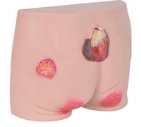 Pressure Ulcers Nursing Model, Decubitus Ulcer Training Model, Healthcare Education Human Simulator with Realistic Image and Skin Feel Real, for Nursing Teaching.