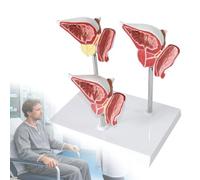 Prostate Anatomical Model, 1:1 Scale Urinary Reproductive System Display, Normal Benign and Diseased Demonstrations for Medical Education and Patient Communication