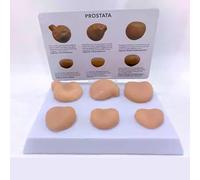 Prostate Lesion Model Set for Medical Teaching, Male Prostate Cancer Anatomy Model with Annotation Card, Human Reproductive Organs Educational Tool