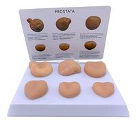 Prostate Lesion Model Set with Mass and Contrast Pathology, Includes Base and Annotation Card for Medical Teaching and Reproductive System Anatomy Education
