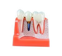 PUFAHAU Dental Implant Teeth Model 4 Times Dentistry Teaching Study Analysis Crown Bridge Removable Dentist Patient Demonstration Model