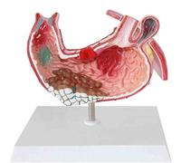 PVC Anatomical Anatomy Model of Human Organs, The Stomach,Gastric Lesion,Gastric Pathology Ulcer Gastritis