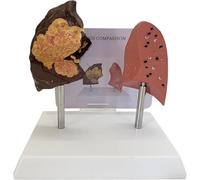 PVC Human Lung Anatomical Model with Pathological Features for Emonstrate The Effects of Smoking On Lung Health