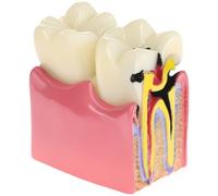 QWORK Educational Dental Caries Teeth Model, 6X Enlarged Cross-Section, Resin Material, for Anatomy Education & Dental Health Teaching