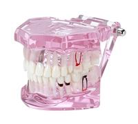 QWORK Professional Dental Implant Study Model Typodont, Realistic Teeth Model with Restoration, Demonstration & Training Tool for Implantology and Prosthetic Education