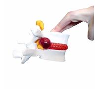 rackbone Anatomical Herniated Lumbar Vertebrae Disc Prolapse Model -Human Medical Anatomy