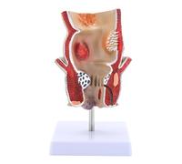 RCULWPLP Human Pathology Rectal Model Teaching Tool for Classroom Learning Study