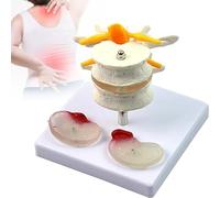 Realistic Human Lumbar Spine Model with Diseased Intervertebral Discs & Spinal Nerves - Anatomical Skeleton for Nursing, Physiology Education & Medical Display
