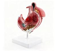 Realistic Human Pathological Stomach Model with Detachable Base, Gastric Ulcer Chronic Atrophic Gastritis Demonstration Model, Anatomical Model for Anatomy and Physiology Teaching Tool