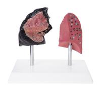 Realistic Puffing Lung Vs Not Smoker Educational Model Permanent PVC Structure Demonstration Tool Comparative Anatomy Model