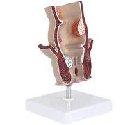 Rectal Pathology Model Hemorrhoid Model, Proctology Retal Disease Demonstration, 5x Anal Canal Anal and Anal Model Anal