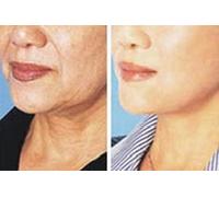 Reduce Eye Bag & Brighten Eyes Via Herbal Essence & Massage
