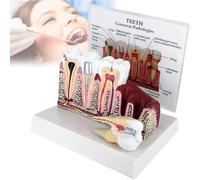 Removable Teeth Anatomical Model, Dental Caries Tooth Model With Common Pathologies, Teeth Dental Pathology Display, High Degree Of Reduction For Education, Patient Communication
