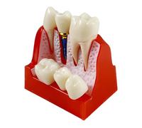 Resin Teaching Tool For Students, 6 Large Detachable Crown Dental Implant Model Teeth, Healthcare Training, Clear Gum And Root Structure