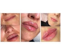 REVOLAX Dermal Filler - Includes Consultation - 0.5ml