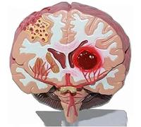Ryanong Brain Anatomical Model, Stroke Model Cerebral Hemorrhage Cerebral arteriovenous Malformation Brain Pathology Biology Teaching Model 1:1 Brain Structure Model Neurology Medical Teaching Aid