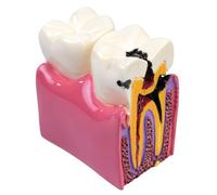Sarini Tooth Model, Caries Comparative Study Model,Dentist Dental Anatomy Educational Tooth Model, Suitable For Dentists Patients Teachers And Students Dental Research And Study