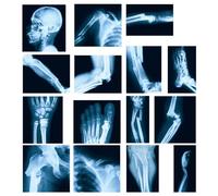 Sayglossy 15 Pcs Broken Bones x Ray Set Human x Rays Black and Blue Skeleton Pretend Xrays for Kids