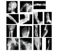 Sayglossy 15 Pcs Broken Bones X Ray Set Human X Rays Black and White Skeleton Pretend Xrays for Kids