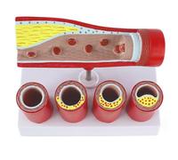 Sclerosis and Thrombosis Model, Human Blood Vessel Model, Pathological Vascular Anatomy Mould for Cardiovascular Artery Coronary Artery-Like Educational Tool