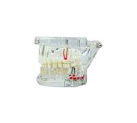 SENLIN DENTAL Transparent Disease Teeth Model with Dental Implant Bridge, Compact and Convenient Dental Models for Patient and Dental Student Education (Transparent)
