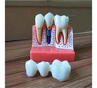 sjdoPulse Dental Implant Model - Dental Practice Implant Model - Tooth Model Dental Implant Demonstration Educational Model - for Lab Dental Demonstration Educational Analysis (A)