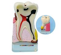 sjdoPulse Dental Pathology Model - Dental Teeth Model - Implant Analysis Demonstration Periodontal Disease Assort Teeth Gums Model - Teeth Gums Standard Demonstration Tool