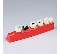 sjdoPulse Dental Teeth Caries Developing Model - Dental Teeth Study Teaching Model - Simulation Oral Tooth Teeth Model for Education Teeth Demonstration Model (A)
