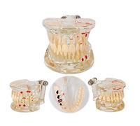 sjdoPulse Pathological Tooth Model, Dental Teaching Model, Some Teeth Are Removable, Suitable for Dental Learning