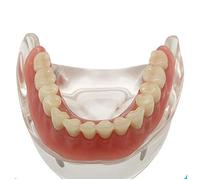 sjdoPulse Teeth Implant Model - Dental Teeth Study Teaching Model - Dental Teeth Study Teaching Model with 2 Implants Overdenture Inferior Study Analysis Demonstration Model (A)