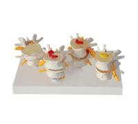 Skeleton Teaching Model 4-Stage Lumbar Spine Lesion Model Human Spine for Science Classroom Study Display Teaching molds