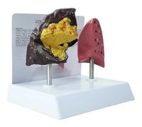 SKUWGW Smoker's Lung vs Healthy Lung Comparative Model - Life Size Anatomical Display for Medical Education, Respiratory Health Study Tool with Pathological Features, PVC Structure