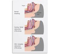 Sleep Apnea Info Poster CPAP Therapy Guide Knowledge Wall Art Canvas for Bedroom Home Office Decor(Unframed,16x24inch(40x60cm))