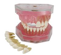 Smile1000 Dental Implant Teeth Model with 28 Removable Teeth for Dental Professionals and Students