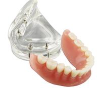 Smile1000 Dental Model Overdenture Inferior 4 Implants Demo for Teaching and Studying
