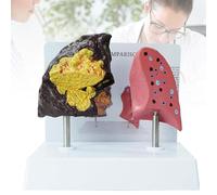 Smoker's Lung & Healthy Lung Comparative Model - Lung Anatomical Model with Pathological Features, Life Size for Students, Doctors, Researchers