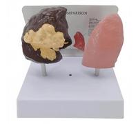 Smoker's Lung vs Healthy Lung Comparative Model, Lung Anatomical Display with Pathological Features, Realistic Lung Display, for Smoking Lung Education, Medical Teaching and Disease Model