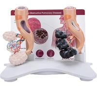 Smoking Alveoli and Healthy Comparison Model Human Alveolar Anatomical, PVC Material, for Health Teaching Models Anatomy Physiology School Education