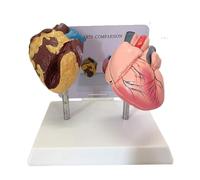 Smoking vs Normal Heart Anatomical Model, Comparative Heart Disease Display Set with Base Medical Teaching Tool Human Torso Model
